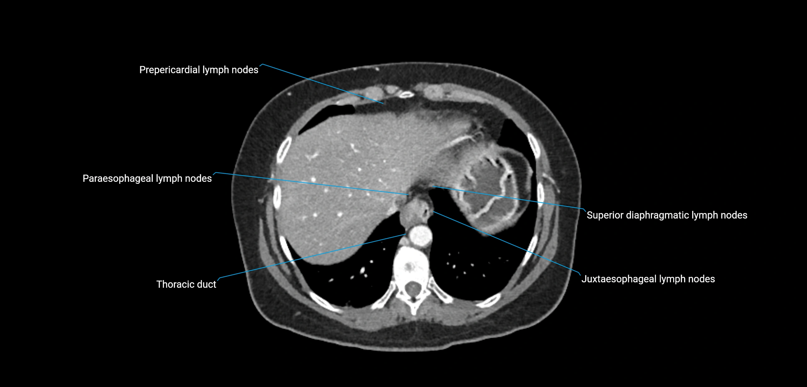CT ct abdominal lymph nodes  axial cross sectional anatomy  enchanced radiology image -img-00002-00075.webp